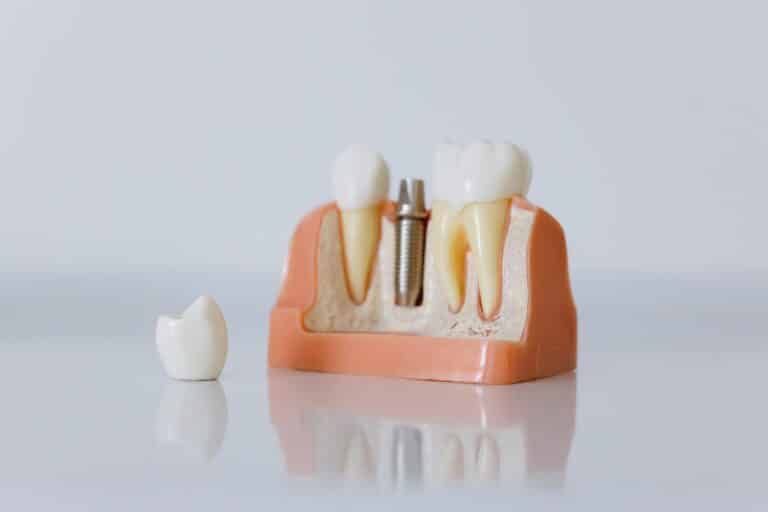 Pose d'implants dentaires : 5 précautions à prendre