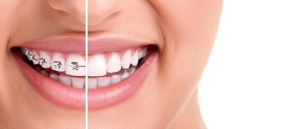 Orthodontie invisible VS orthodontie classique : le guide complet pour enfants, ados et adultes